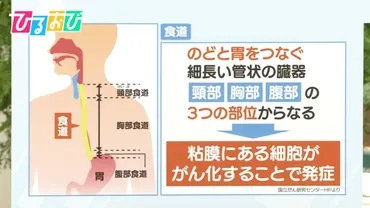 早期発見が゛難しい゛「食道がん」自覚症状や発見の機会は?【ひるおび】