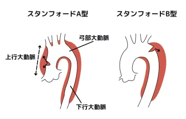 大動脈解離の症状はどんなものがある?検査、治療、予防法も紹介!(医師監修)