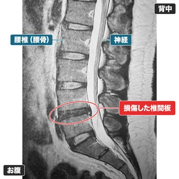 必要なのは減圧治療(やセルゲル法)か修復治療(ディスクシール治療)か