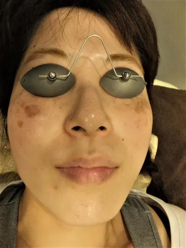 皮膚科専門医による施術】シミ取りレーザー治療へのこだわり（品川院・銀座院・日本橋院） 