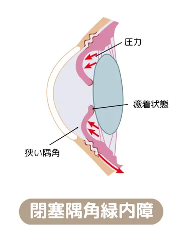 緑内障にお悩みの方へ 