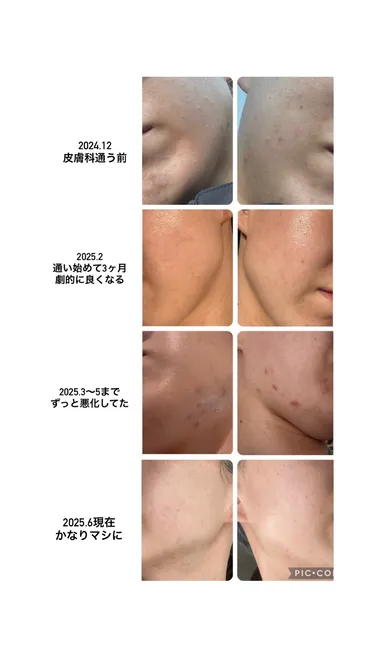 相澤皮膚科さんでニキビ治療② 