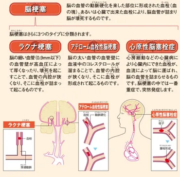 脳梗塞ってどんな病気？原因や症状、早期発見のための対策を解説！脳梗塞、見落とさないで！初期症状と早期受診の重要性