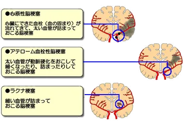 脳梗塞
