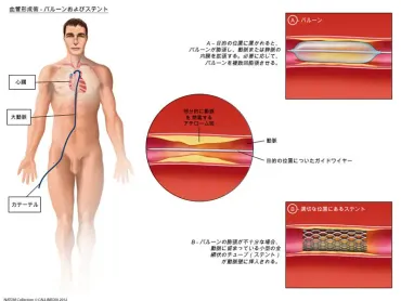 心筋梗塞(急性冠症候群)