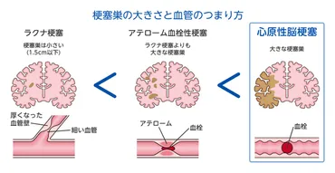 心原性脳塞栓症