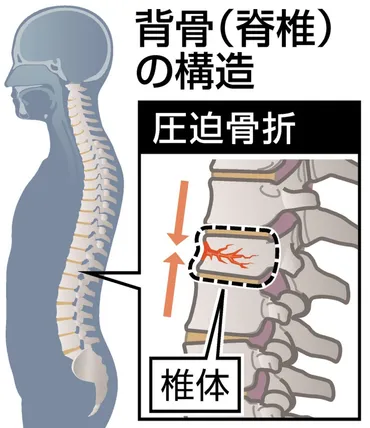 いつのまにか骨折」=圧迫骨折で寝たきりリスクも 「おへそ引っ込み体操」で背骨の骨量アップ!:中日新聞Web