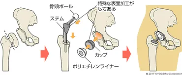 人工股関節置換術の低侵襲手術