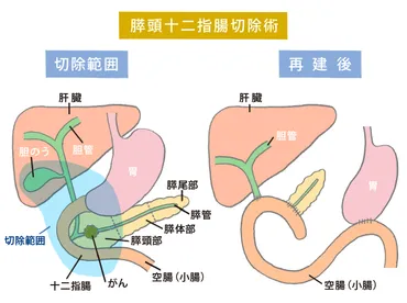 白い巨塔」に学ぶ膵がん手術の知識