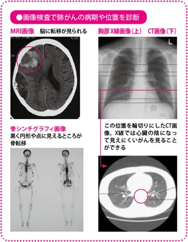 肺がん治療の現在と未来：ステージ4でも諦めない希望とは？肺がん、治療、生存率、そして患者と家族の支え