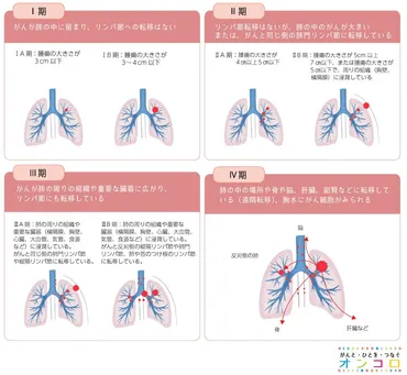 肺がんステージ4とは？症状と治療法、そして希望を見出すために肺がんステージ4の基礎知識と治療の最前線