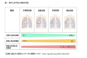 肺がん(原因、種類、症状、治療法、生存率)とは？早期発見が重要な理由？肺がんの基礎知識：原因、種類、症状、治療法、早期発見の重要性