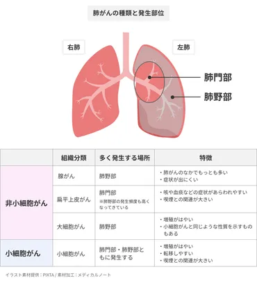 肺がんとは？早期発見のための知識と治療法を解説？肺がんの基礎知識と最新治療