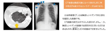 低線量CT検査」で、肺がんを早期発見！ 