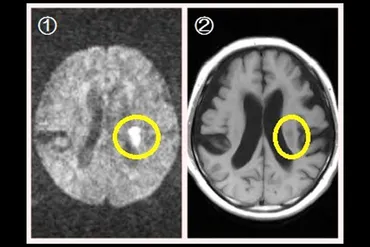 脳梗塞ってどう写るの?~CTとMRIで比較してみました~ – 医療法人社団倫生会 みどり病院