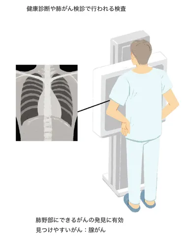 肺がん、早期発見への道？初期症状、リスク、検診、生存率、治療法を徹底解説肺がん ～早期発見の重要性～