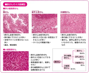 肺がん治療方針の決定と治療法選択、そのために必要な検査とは？ – がんプラス
