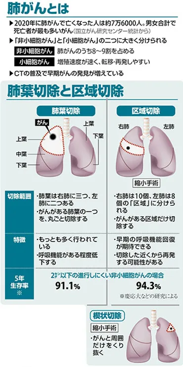 早期肺がんの５年生存率…「肺葉切除」と、取り除く範囲を小さい「区域切除」では、どちらが高い？ 