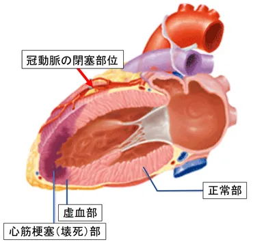 虚血性心疾患：急性心筋梗塞の診断と治療 – 医療法人恵山会 丸山病院