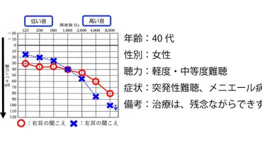 より聞きやすく】突発性難聴とメニエール病の方、補聴器で改善パートナーズ補聴器