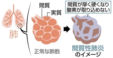 特発性大腿骨頭壊死症と間質性肺炎ってどんな病気？早期発見が鍵を握る？股関節の痛みと呼吸困難…それぞれの病気の原因と治療法