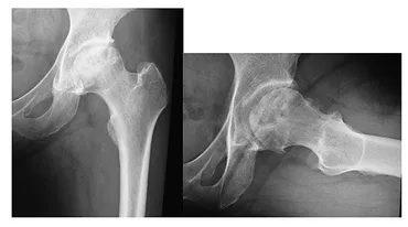 大腿骨頭壊死症