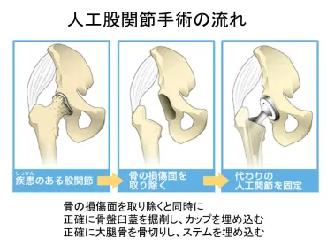 人工股関節置換術 (THA: Total Hip Arthroplasty)