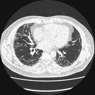 美空ひばりと病（間質性肺炎、肝硬変、大腿骨頭壊死症）- 歌姫の闘病と死、原因と治療法とは？歌姫たちの病（間質性肺炎、肝硬変、大腿骨頭壊死症）
