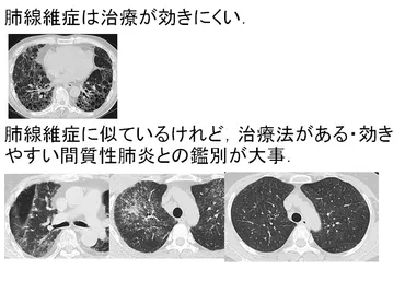 特発性間質性肺炎（IIPs：Idiopathic interstitial pneumonias） : ピクトグラムでわかる呼吸器内科