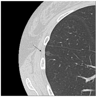 肺がんを徹底解説！早期発見と治療の最前線とは？肺がんの基礎知識から最新治療、そして患者と家族ができること