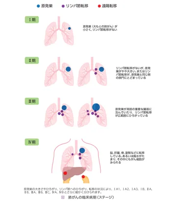 Q27肺がんの治療はどのように決めていくのですか〜臨床病期（ステージ）と治療選択〜