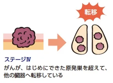 ステージⅣ、および再発の゛がん゛とは?
