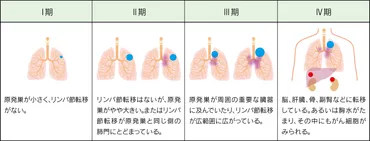 肺がんステージ4とは？症状・生存率・治療法を詳しく解説？肺がんステージ4：診断から終末期までの全情報