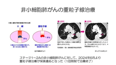 2025年度版】肺がん治療全解説！治療や新薬、喫煙との関係とは？