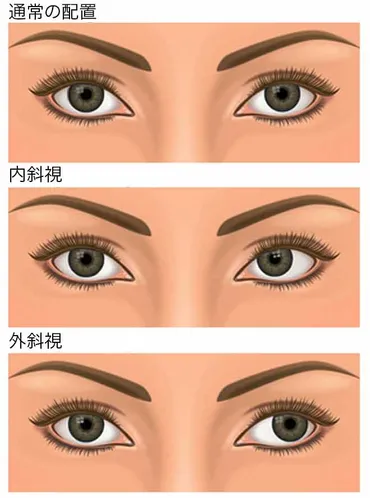 斜視(寄り目):原因と対応