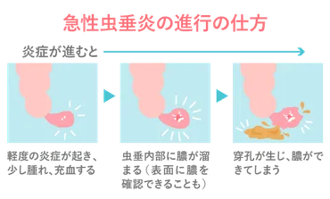 盲腸(急性虫垂炎)の疑いなら、緑区の消化器内科のさくら医院